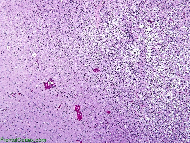 H&E Stain of a Pilocytic Astrocytoma